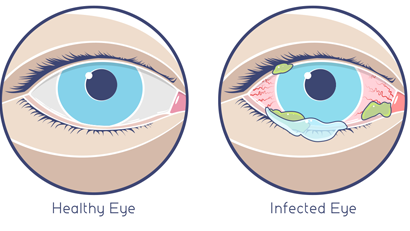 On the left, a picture of a healthy eye. On the right, a picture of an infected eye with redness and discharge.